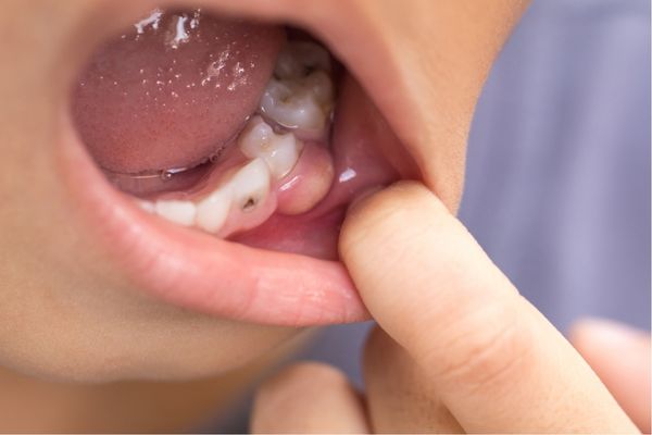 How To Get Rid of Cavities and Tooth Decay