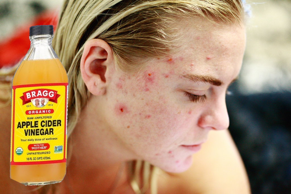 Harnessing the Power of Nature: A Guide to Using Apple Cider Vinegar on Skin for Acne, Spots, and Other Skin Problems