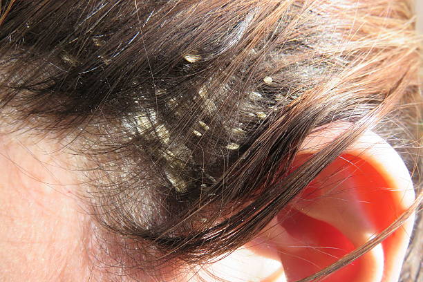 how to get rid of dandruff ? Definition, Causes, Treatements