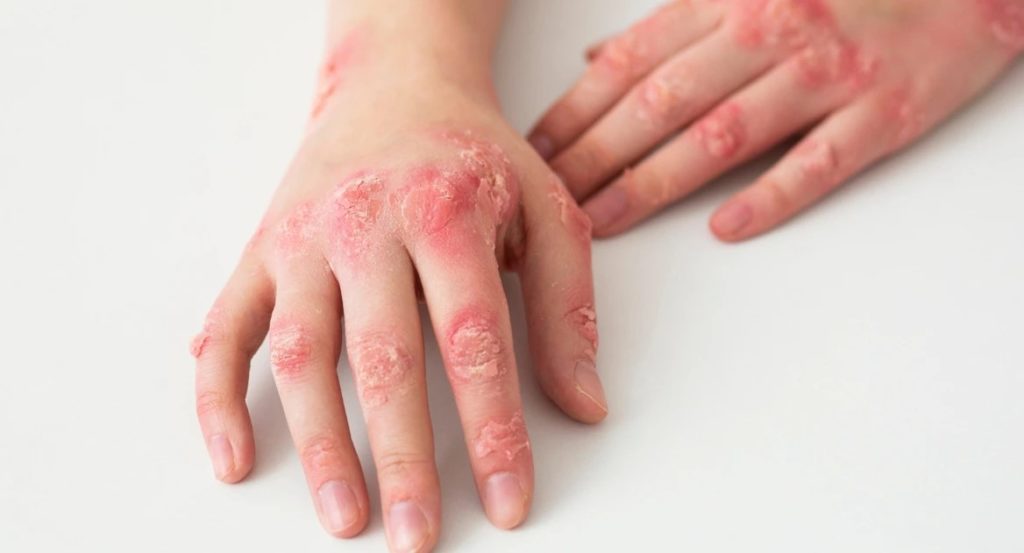 7 Types of Eczema, What Do Atopic Dermatitis and Other Eczema Types Look Like?