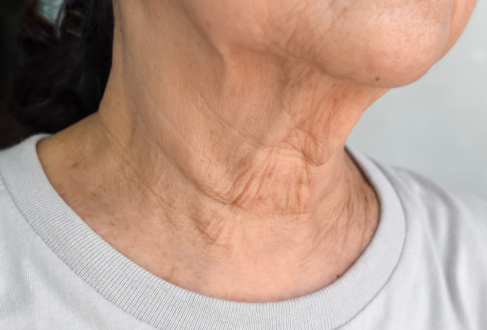 How to Get Rid of Neck Wrinkles Naturally?