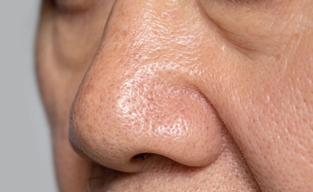 How To Get Rid of Open Pores Naturally at Home?