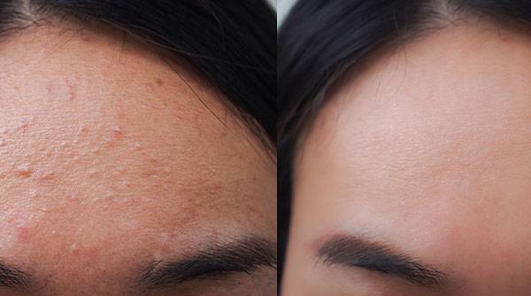 How To Reduce Forehead Acne