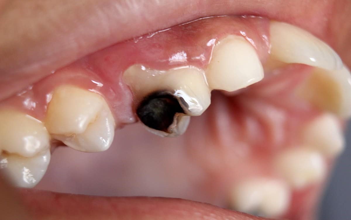 5 steps for healing your tooth decay and reverse cavities