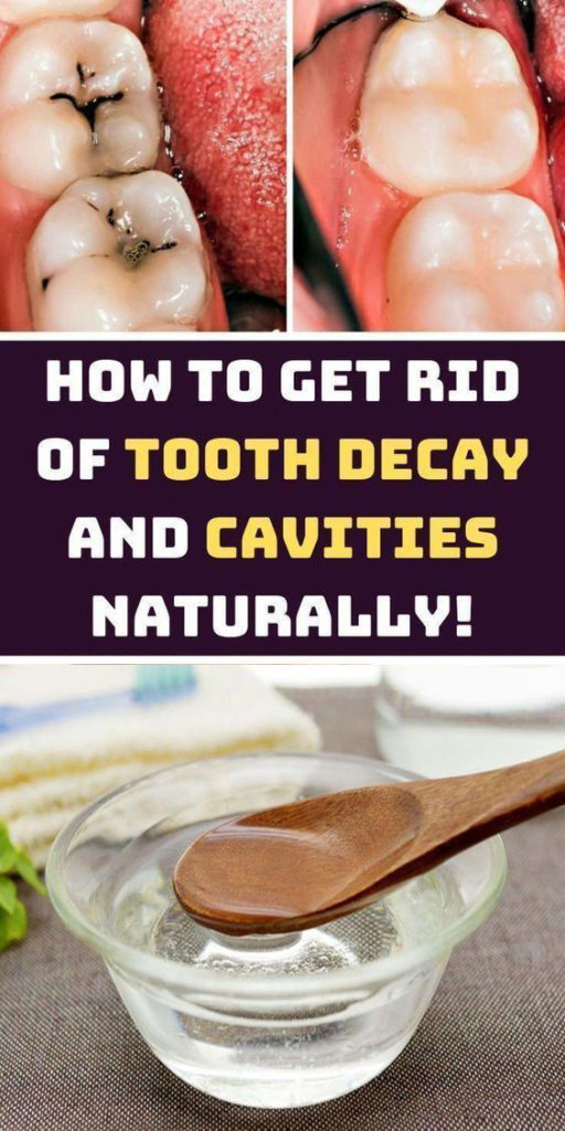 6 Natural Ways to Reverse Tooth Decay