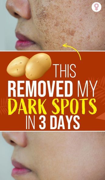 Using Potato Juice, You Can Remove Dark Spots In Just 3 Days